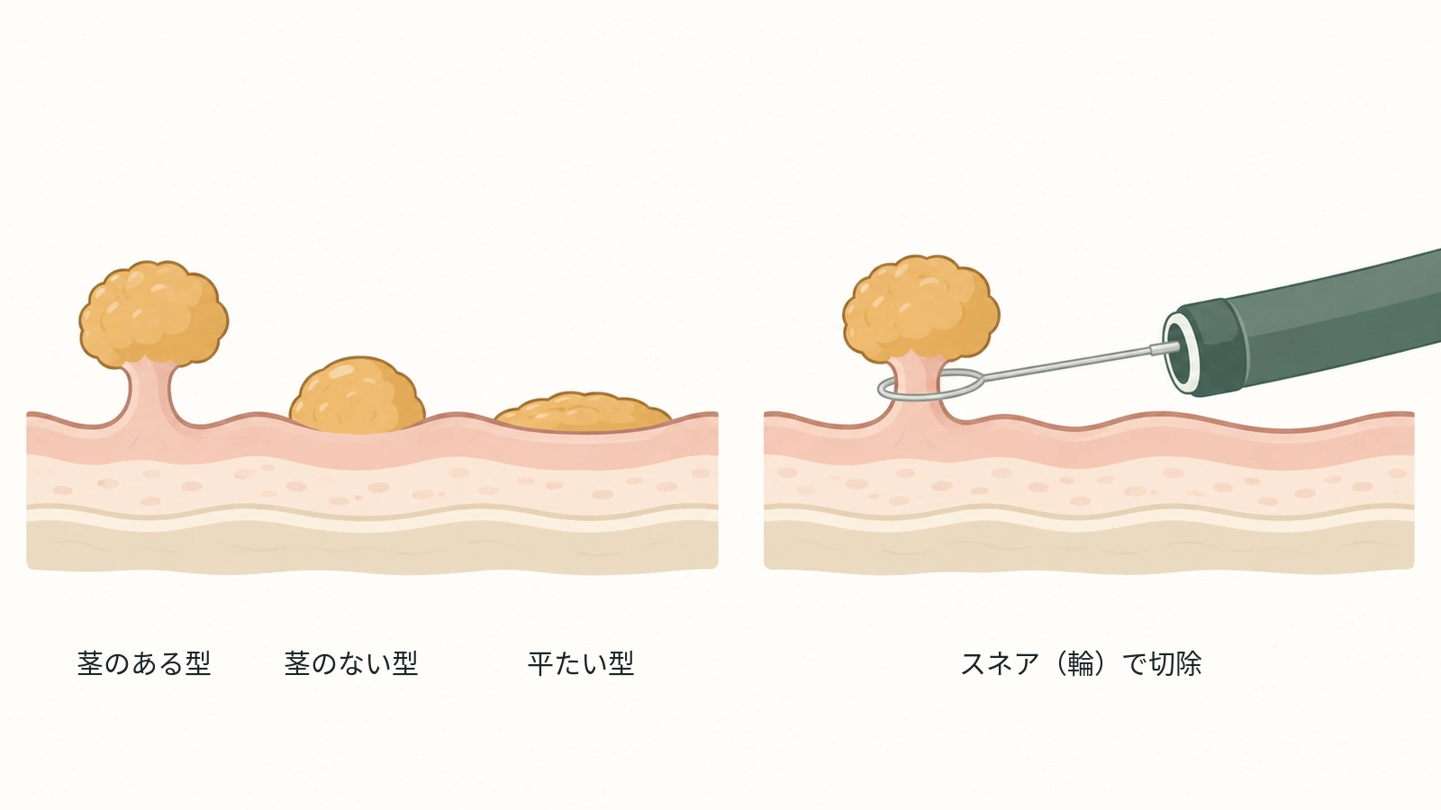 大腸ポリープの3つの形と、内視鏡の輪でポリープを切除する様子を示した図