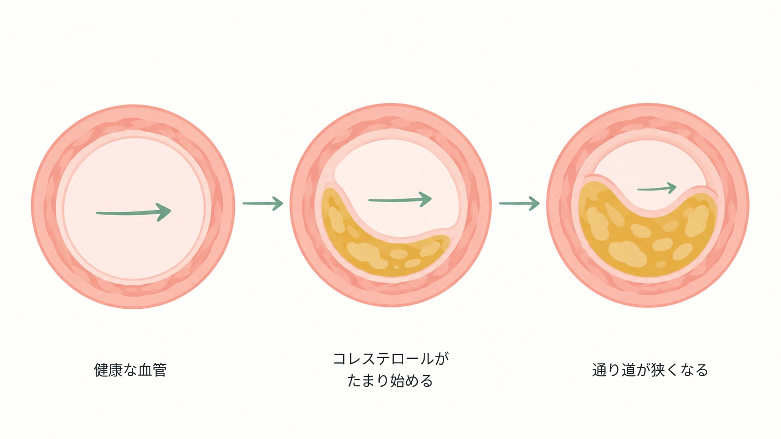 健康な血管から、壁にコレステロールがたまり、通り道が狭くなるまでの3段階を示した断面図